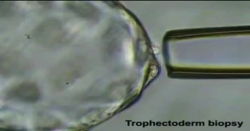 Preimplantasyon Genetik Tanı Uygulamasında Trofektoderm Biyopsi Yöntemi