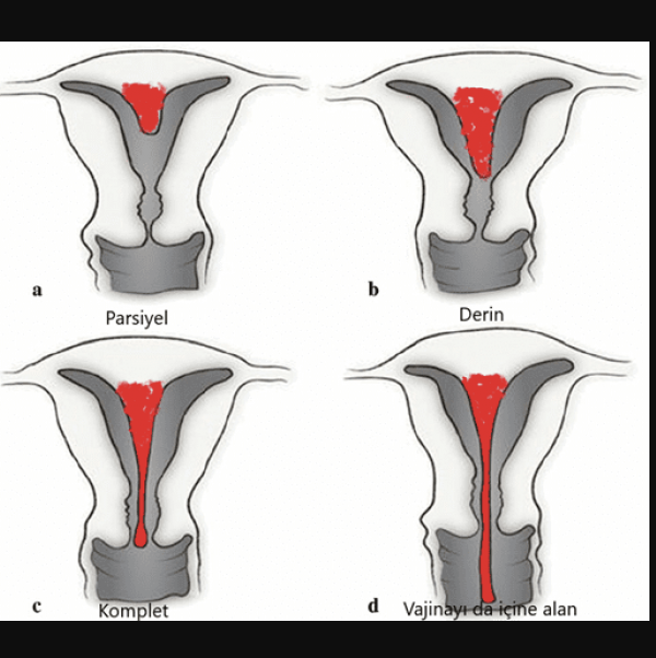 Uterin Septum (Rahim İçi Perde) Nedir?