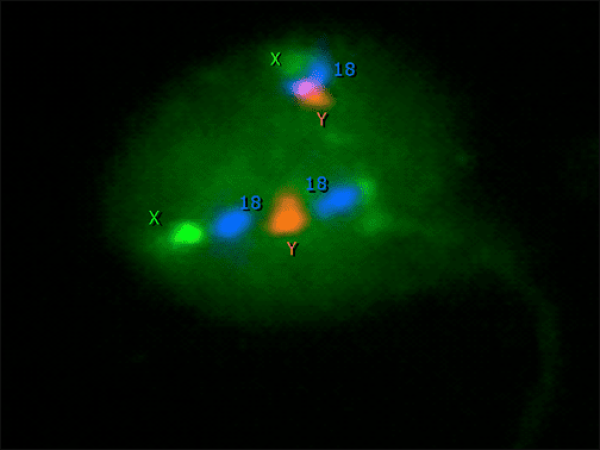  Büyük baş (Makrosefali-Megalohead) Sperm Sendromu