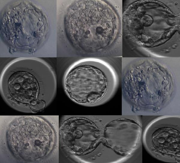 Öploid embriyoda nekrotik odakların ve/ veya ayrı blastomerlerin varlığı dondurulmuş çözülmüş embriyo transfer sikluslarında gebelik sonuçlarını etkiler mi?