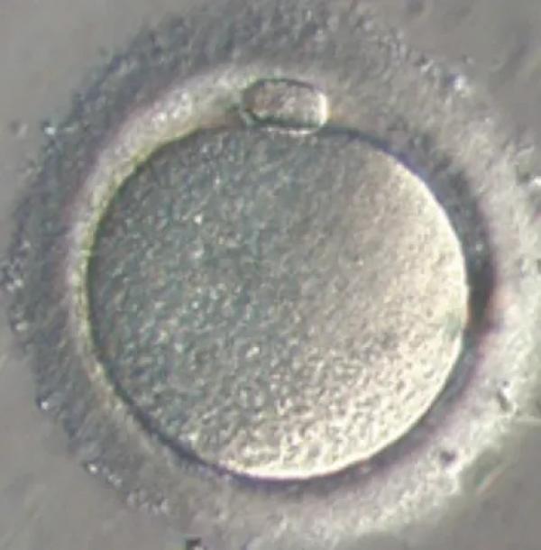 Oosit (Yumurta) Dondurma Nedir, Kimlere ve Nasıl Uygulanır?