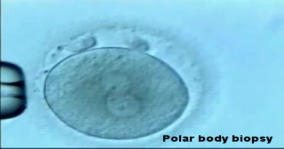 Preimplantasyon Genetik Tanı Uygulamasında Polar Hücre Biyopsi Yöntemi