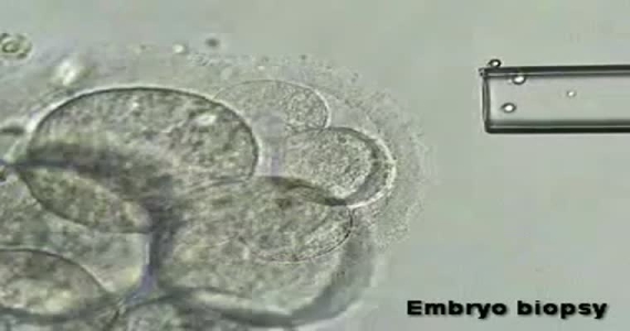 Preimplantasyon Genetik Tanı Uygulamasında Embriyo (Blastomer) Biyopsi Yöntemi
