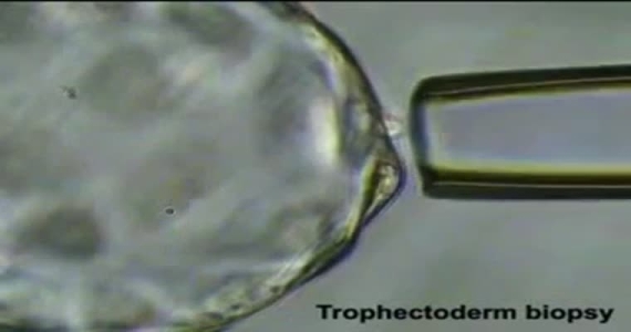 Preimplantasyon Genetik Tanı Uygulamasında Trofektoderm Biyopsi Yöntemi